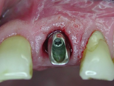 21 Abutment loaded.jpg